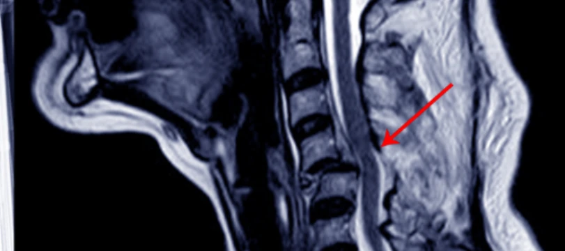 Baltimore Spinal Cord Injury Lawyer